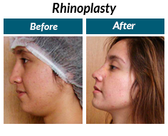 rinoplastia